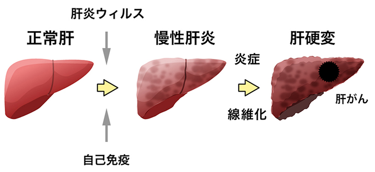 肝硬変のその他の危険因子