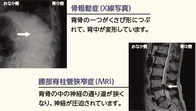 骨粗鬆症(X線写真) 背骨の一つがくさび形につぶれて、背中が変形しています。　腰部脊柱管狭窄症(MRI) 背骨の中の神経の通り道が狭くなり、神経が圧迫されています。